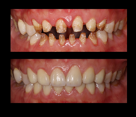 数码氧化锆全瓷牙案例展示1