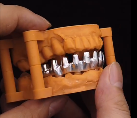 半口义齿支架展示(马龙桥支架)